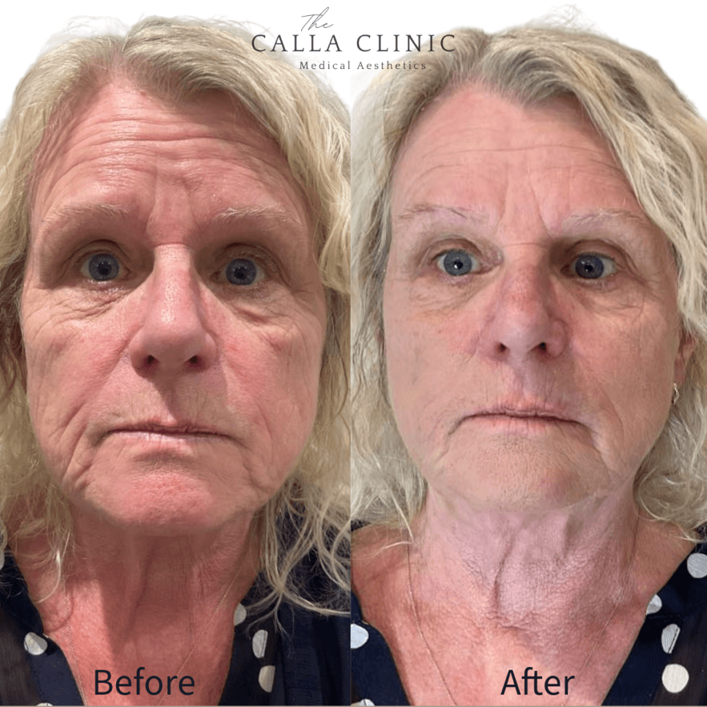 Before and after of dermal filler results treated by Nurse and Doctor team at The Calla Clinic