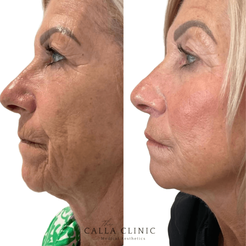 Before and after of dermal filler results treated by Nurse and Doctor team at The Calla Clinic