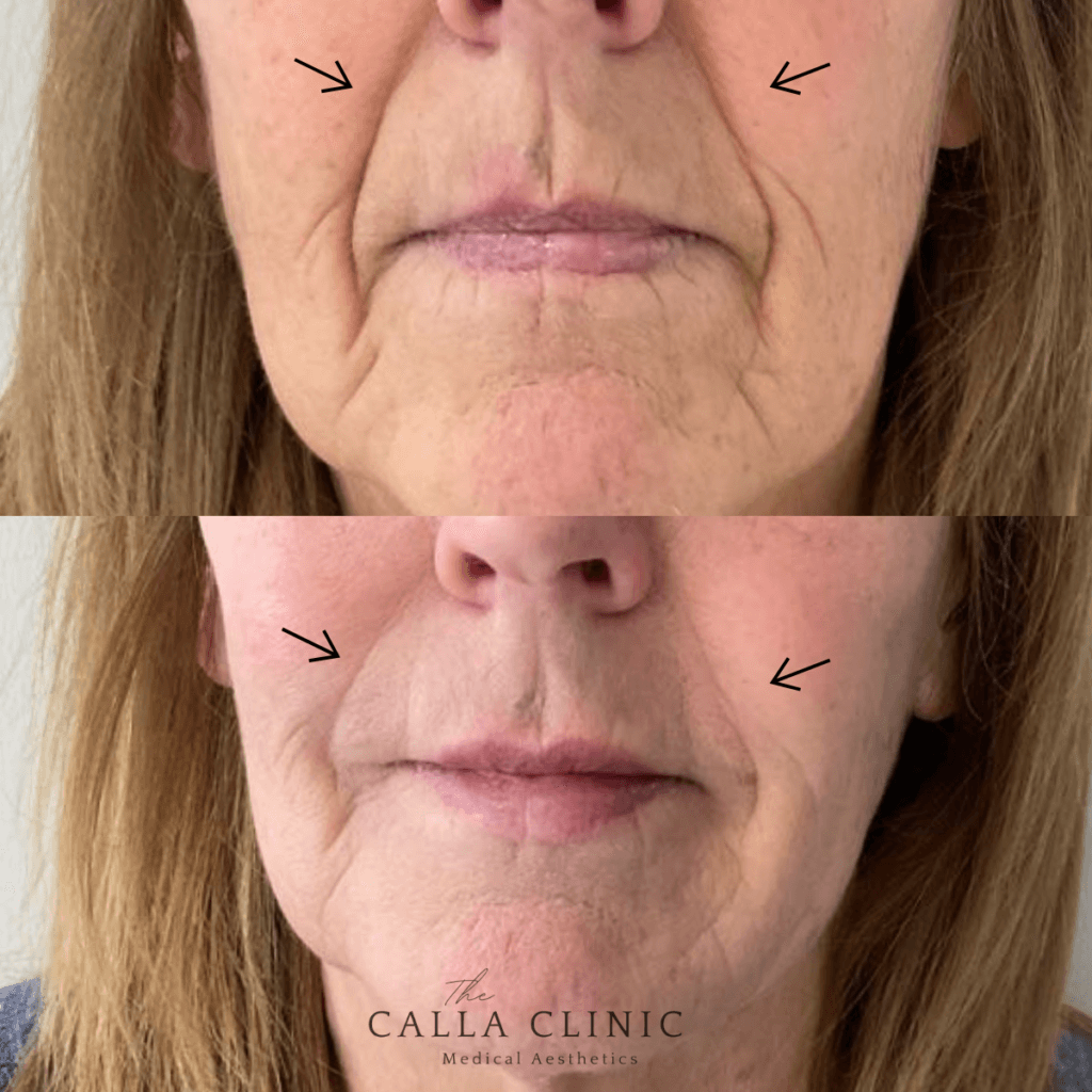 Before and after of dermal filler results treated by Nurse and Doctor team at The Calla Clinic