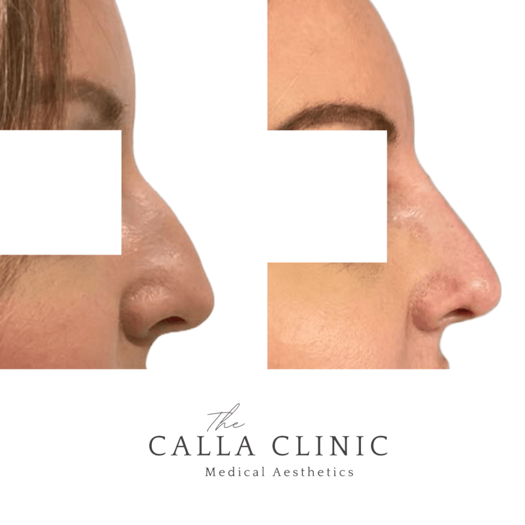 Before and after of dermal filler results treated by Nurse and Doctor team at The Calla Clinic.