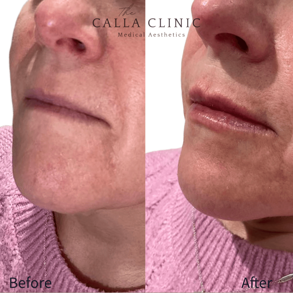 Before and after of dermal filler results treated by Nurse and Doctor team at The Calla Clinic