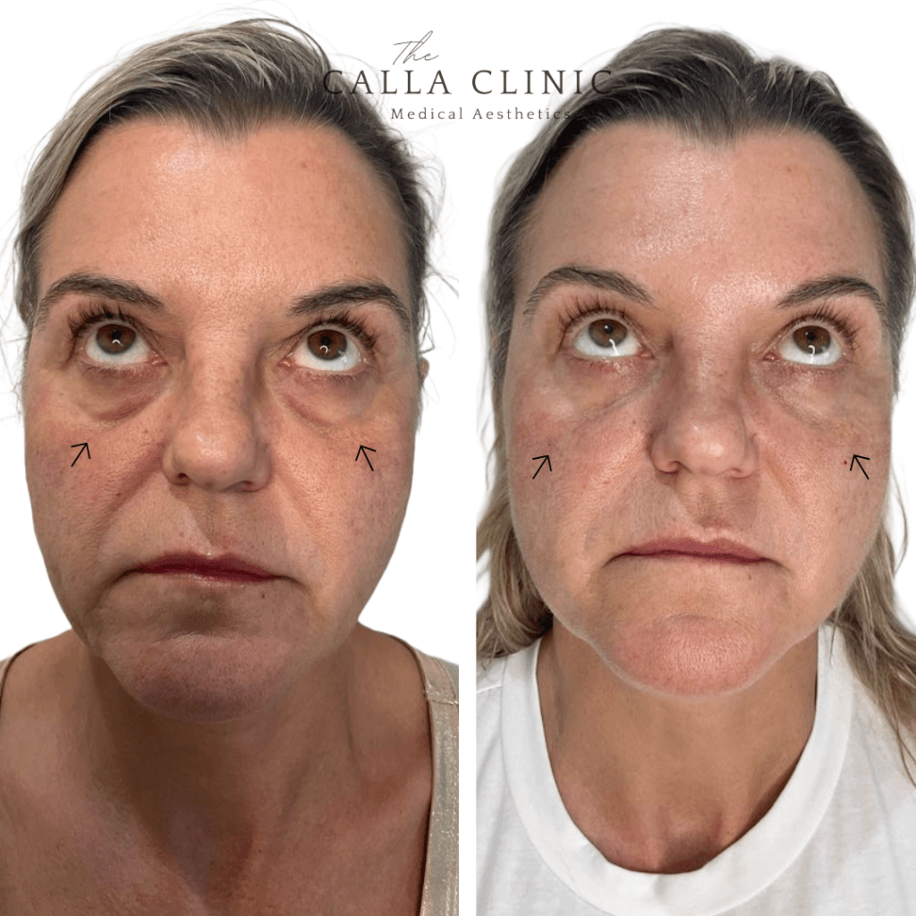 Before and after of dermal filler results treated by Nurse and Doctor team at The Calla Clinic
