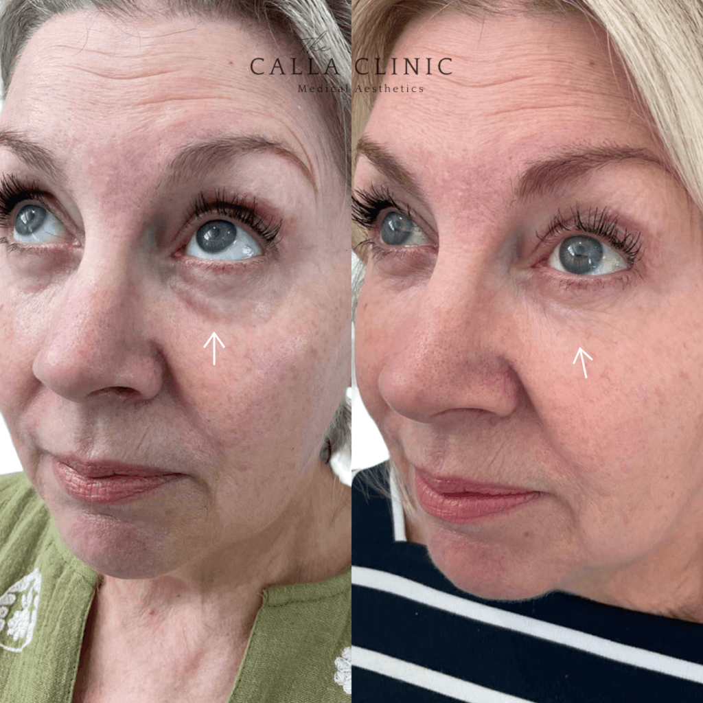 Before and after of dermal filler results treated by Nurse and Doctor team at The Calla Clinic