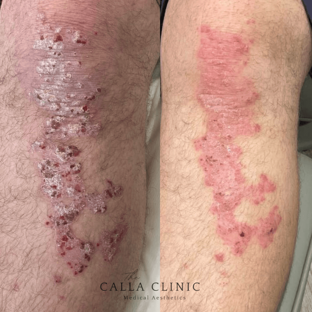 Before and after results of Dermalux used to treat skin conditions alongside prescriptive skincare.