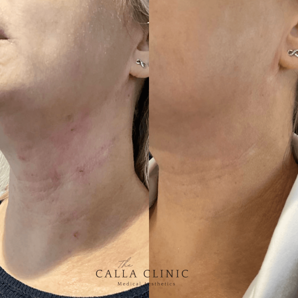 Before and after results of Dermalux used to treat skin conditions alongside prescriptive skincare.