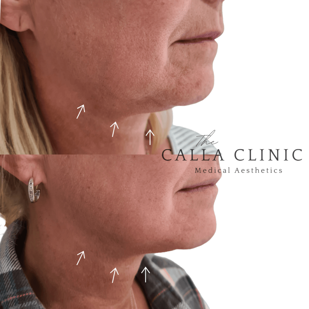 Before and after two treatments of Morpheus 8 for jawline definition and jowl reduction