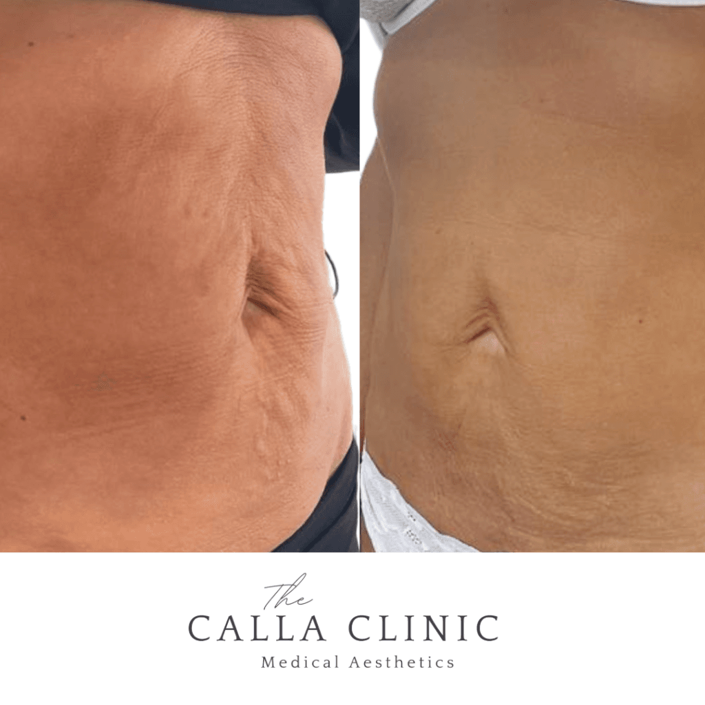 Before and after two treatments of Morpheus 8 combined with PRP for abdominal skin laxity.