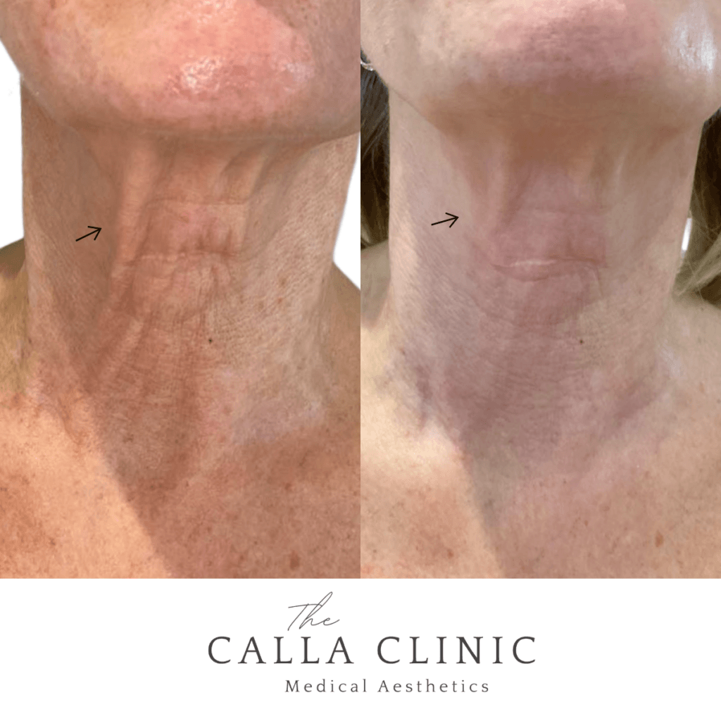 Before and after two treatments of Morpheus 8 combined with PRP for neck tightening.