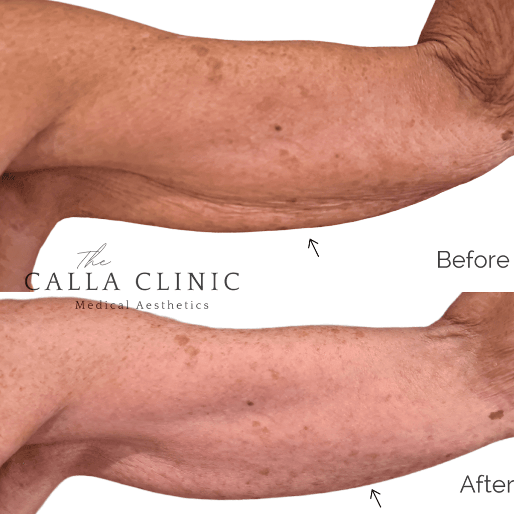 Before and after three treatments of Morpheus 8 combined with PRP for arm skin tightening