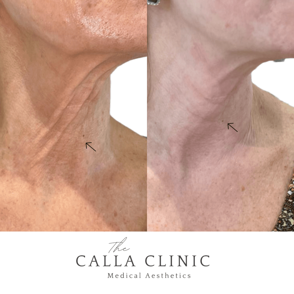 Before and after two treatments of Morpheus 8 combined with PRP for neck tightening