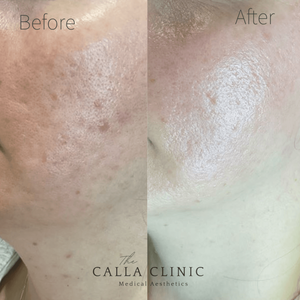 Before and after three treatments of Morpheus 8 for acne scarring.