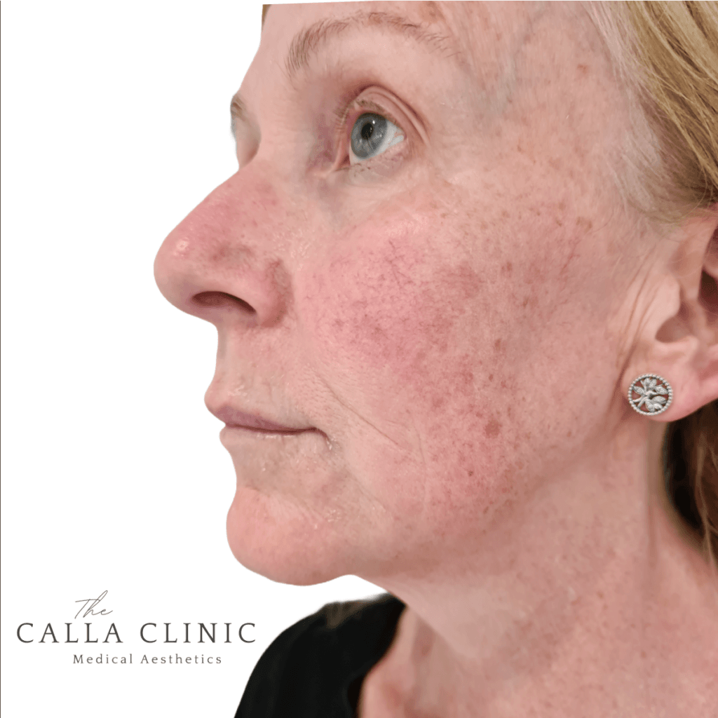 Before Profhilo treatment, skin appears dull and dehydrated.