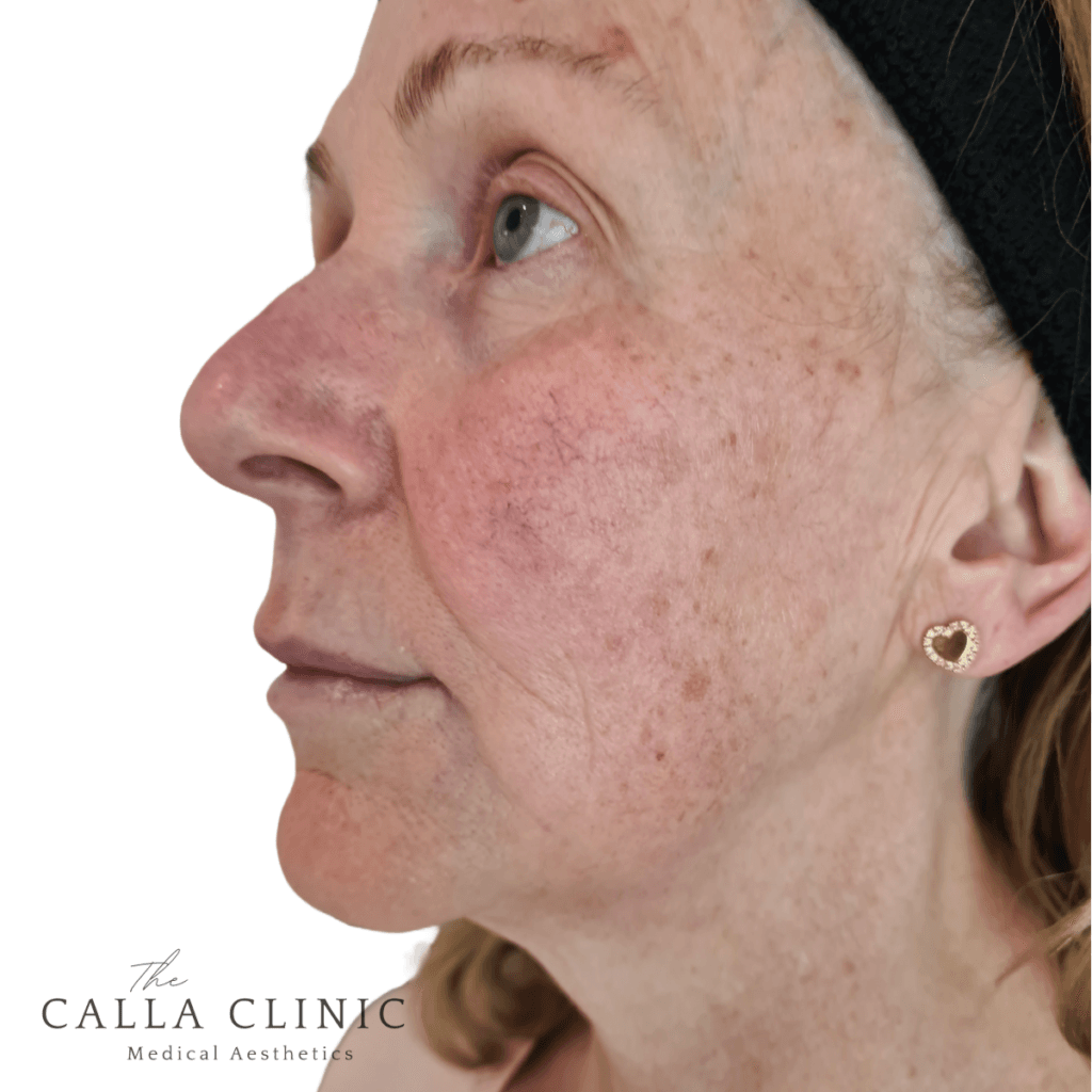 After Profhilo treatment, skin appears plumper, firmer and more radian