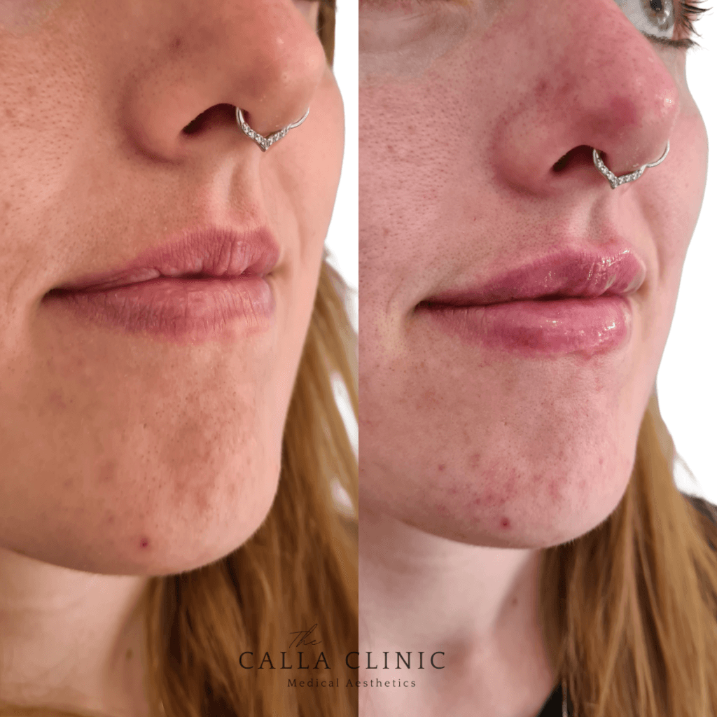 Before and after of dermal filler results treated by Nurse and Doctor team at The Calla Clinic