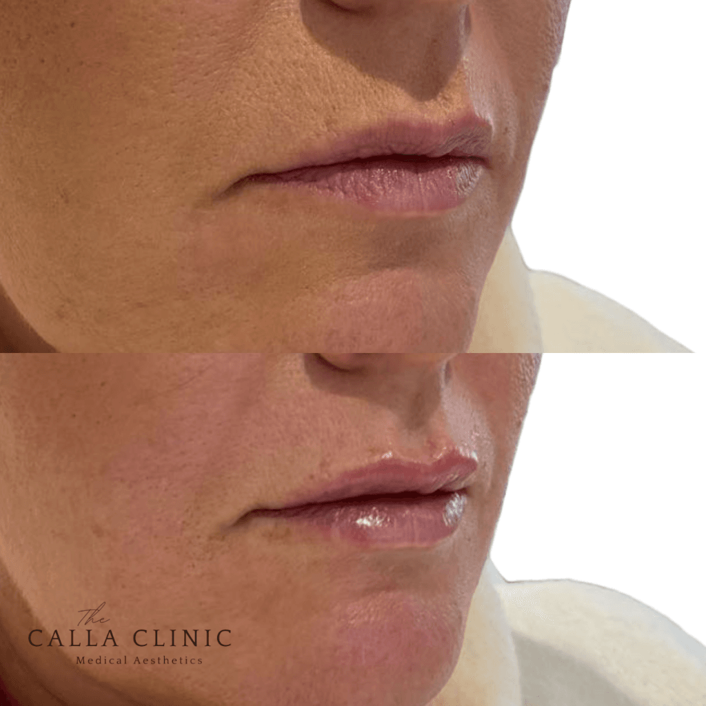Before and after of dermal filler results treated by Nurse and Doctor team at The Calla Clinic.