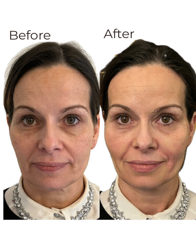 Before and after a Cog Thread Lift by Nurse Cheryl